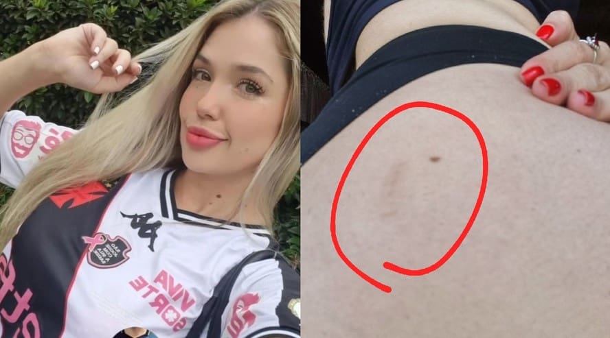 Larissa Ferrari exibe lesão na região glútea — Foto: Reprodução/Instagram